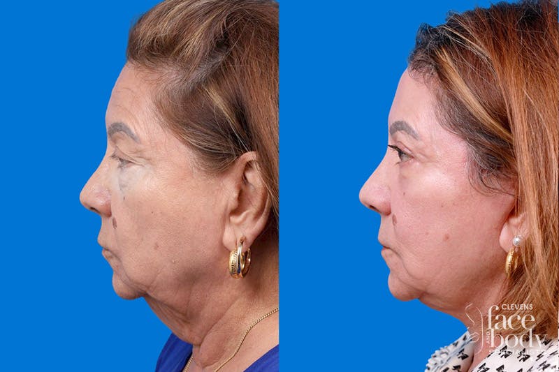 Eyelid Surgery Before & After Gallery - Patient 194128 - Image 5