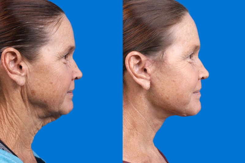 Facelift Before & After Gallery - Patient 159252 - Image 3