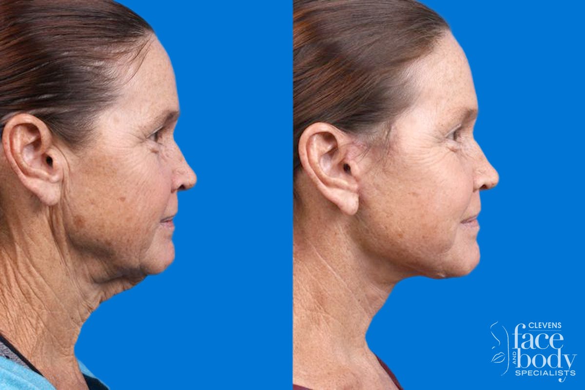 Facelift Before & After Gallery - Patient 159252 - Image 1
