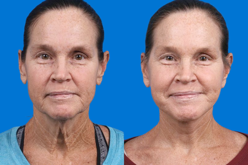 Facelift Before & After Gallery - Patient 159252 - Image 1