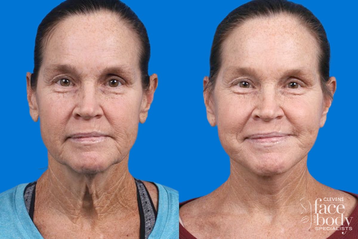 Facelift Before & After Gallery - Patient 159252 - Image 3
