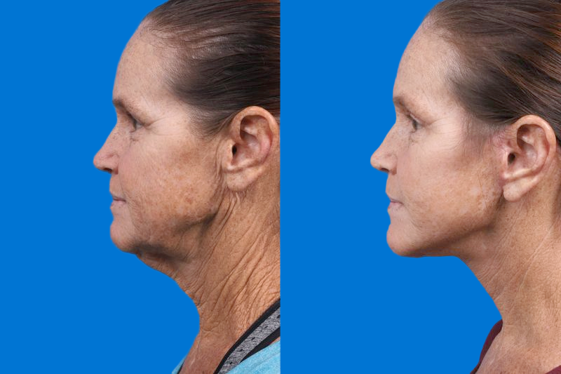 Facelift Before & After Gallery - Patient 159252 - Image 5