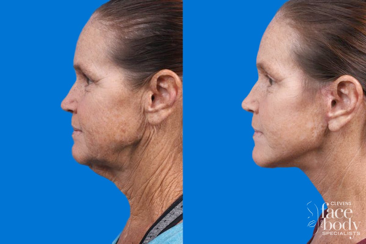 Facelift Before & After Gallery - Patient 159252 - Image 2
