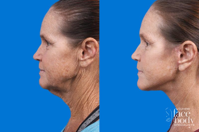 Facelift Before & After Gallery - Patient 159252 - Image 2