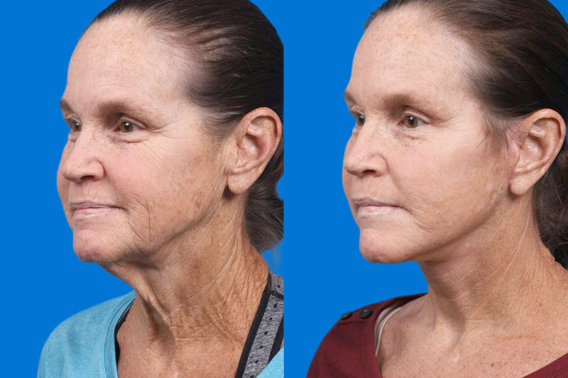 Facelift Before & After Gallery - Patient 159252 - Image 4