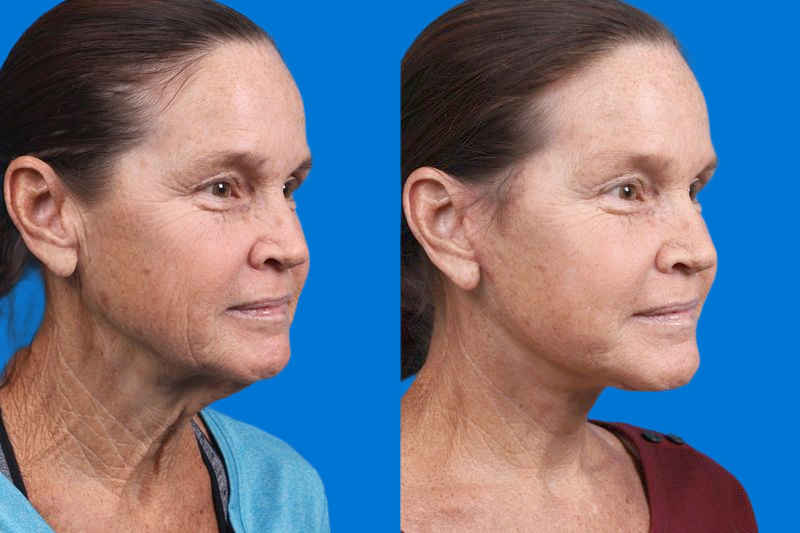 Facelift Before & After Gallery - Patient 159252 - Image 2