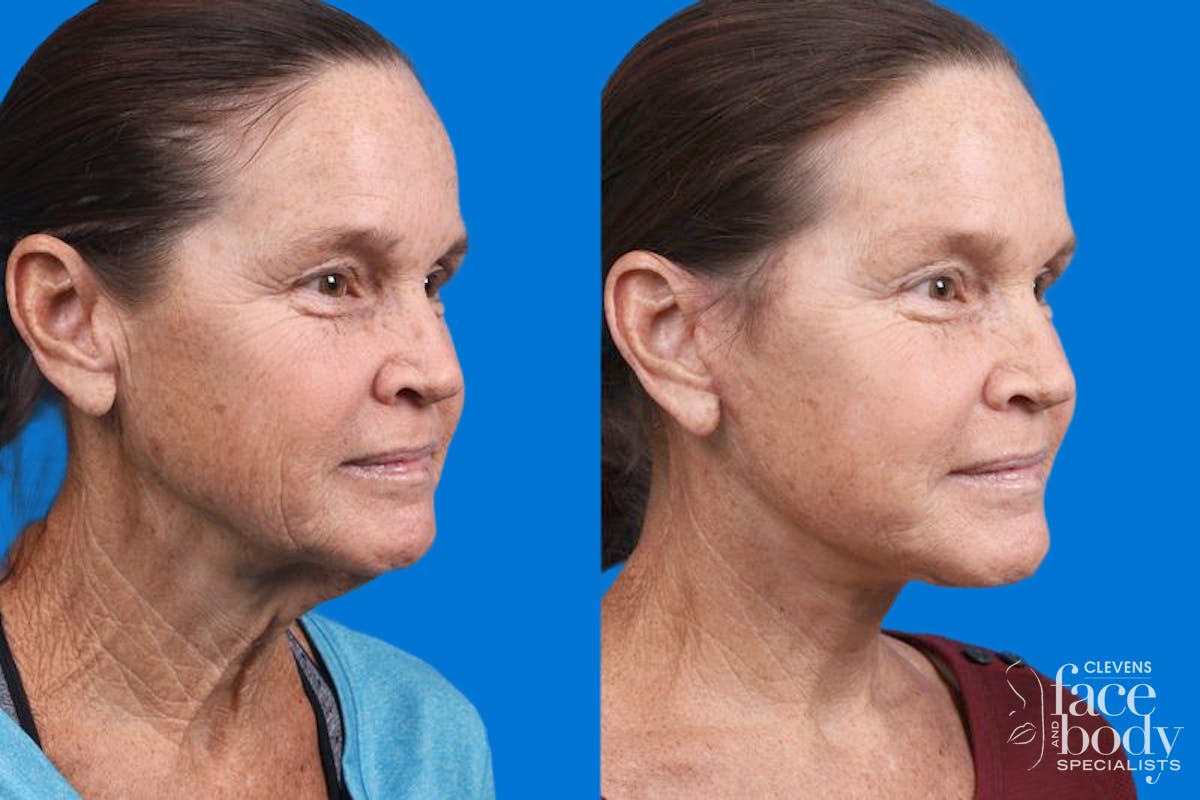 Facelift Before & After Gallery - Patient 159252 - Image 4