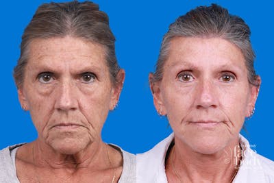 Eyelid Surgery Before & After Gallery - Patient 255884 - Image 1