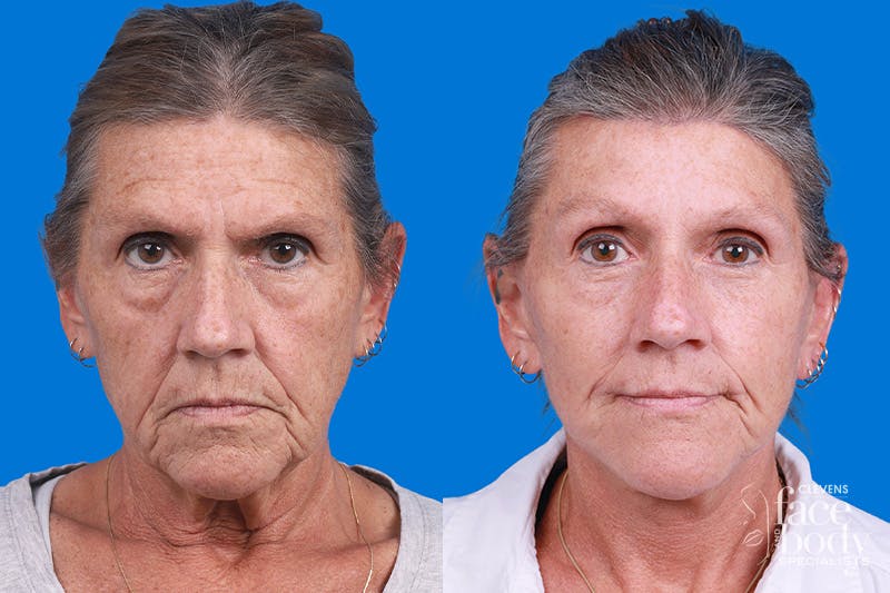 Eyelid Surgery Before & After Gallery - Patient 255884 - Image 1
