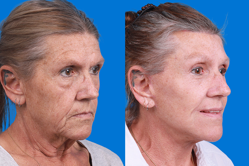 Eyelid Surgery Before & After Gallery - Patient 255884 - Image 2