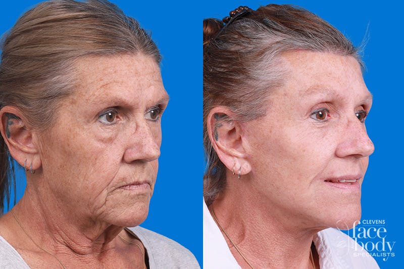 Eyelid Surgery Before & After Gallery - Patient 255884 - Image 2