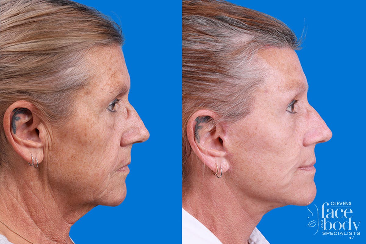 Eyelid Surgery Before & After Gallery - Patient 255884 - Image 3