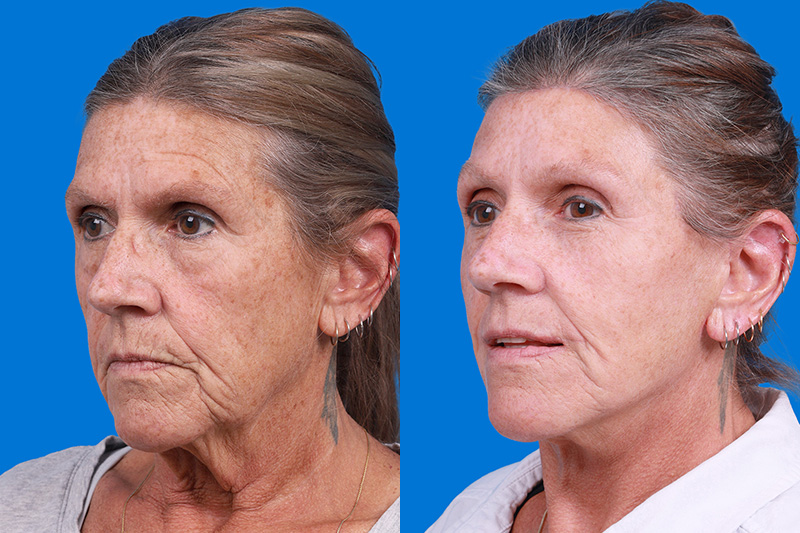 Eyelid Surgery Before & After Gallery - Patient 255884 - Image 4