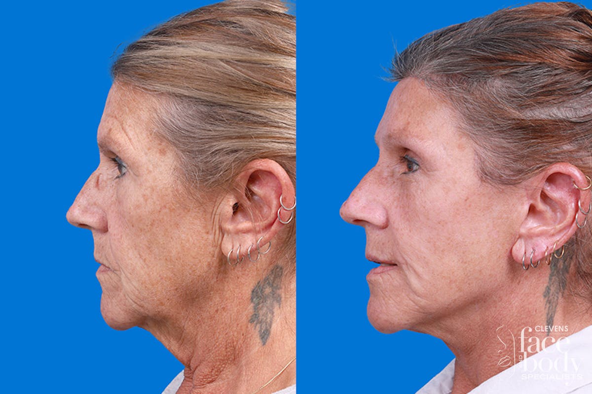Eyelid Surgery Before & After Gallery - Patient 255884 - Image 5