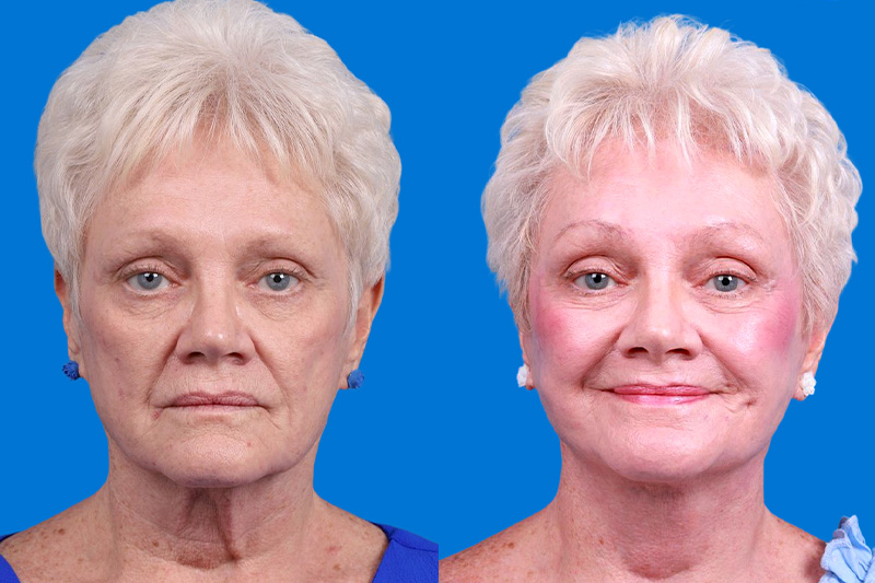 Facelift Before & After Gallery - Patient 246738 - Image 1
