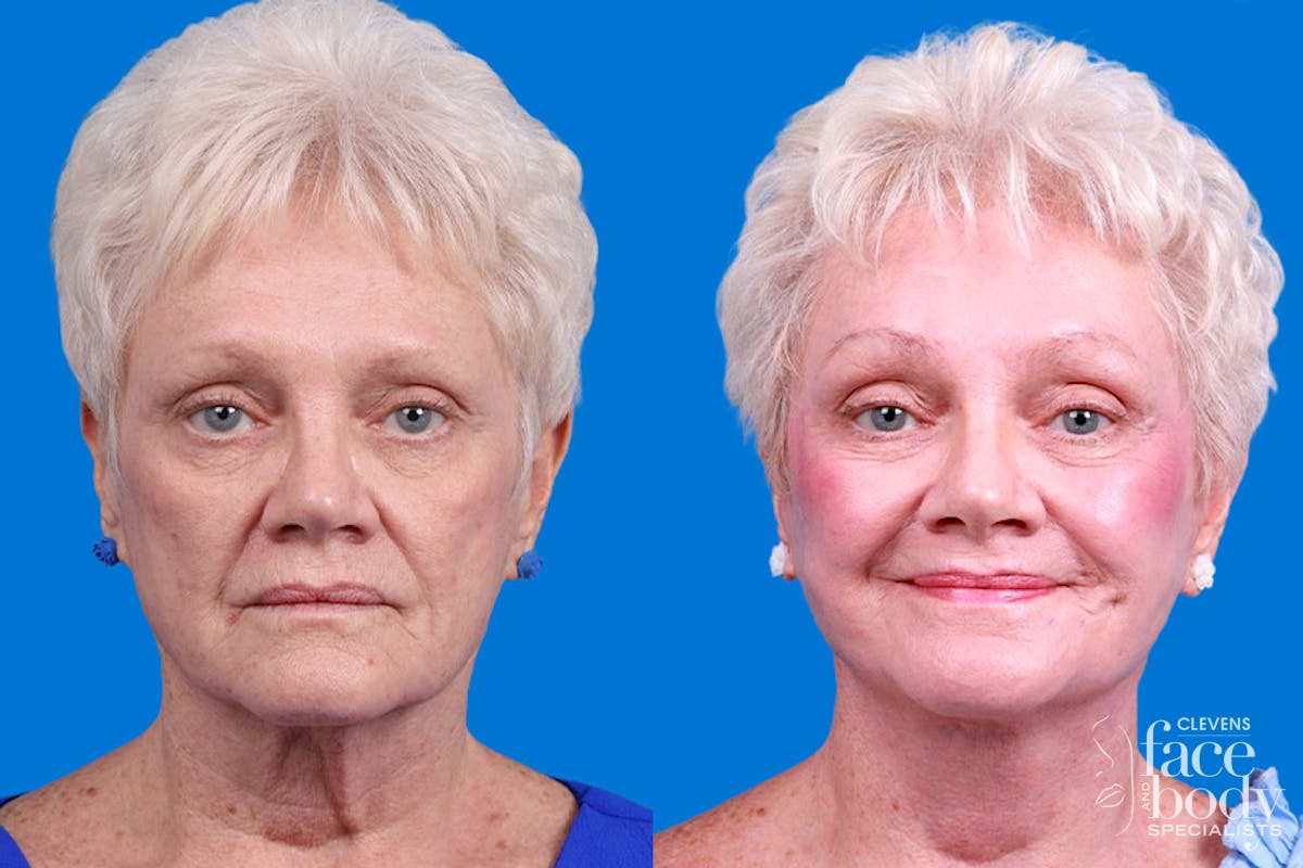 Facelift Before & After Gallery - Patient 246738 - Image 1