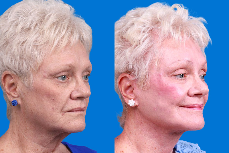 Facelift Before & After Gallery - Patient 246738 - Image 2