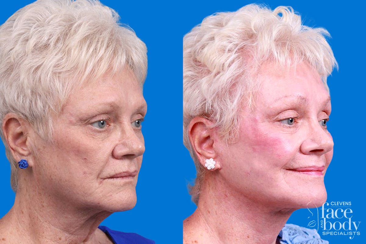 Facelift Before & After Gallery - Patient 246738 - Image 2