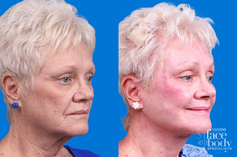 Facelift Before & After Gallery - Patient 246738 - Image 2