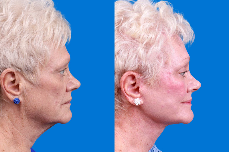 Facelift Before & After Gallery - Patient 246738 - Image 3