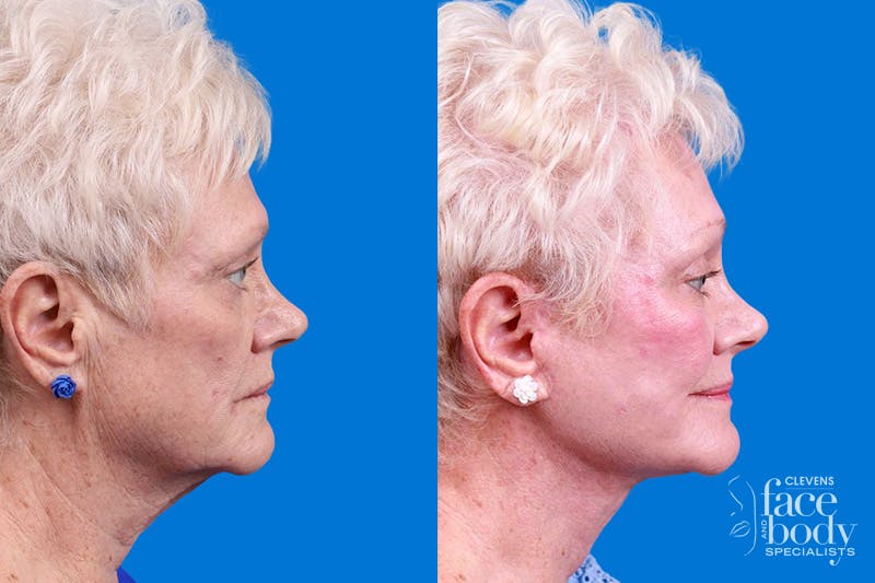 Facelift Before & After Gallery - Patient 246738 - Image 3
