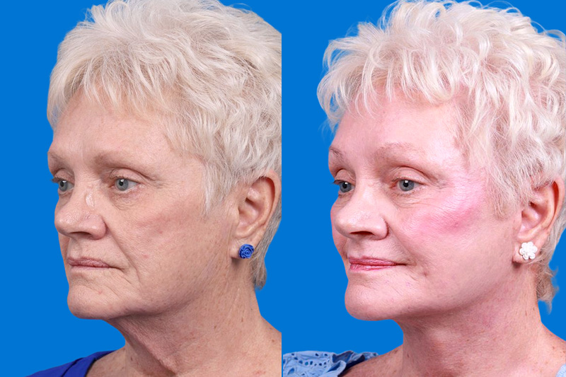 Facelift Before & After Gallery - Patient 246738 - Image 4