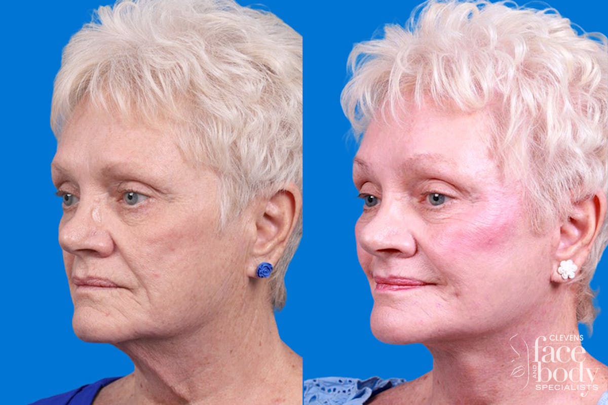 Facelift Before & After Gallery - Patient 246738 - Image 4