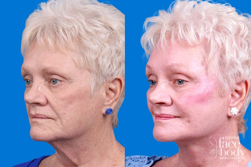 Facelift Before & After Gallery - Patient 246738 - Image 4
