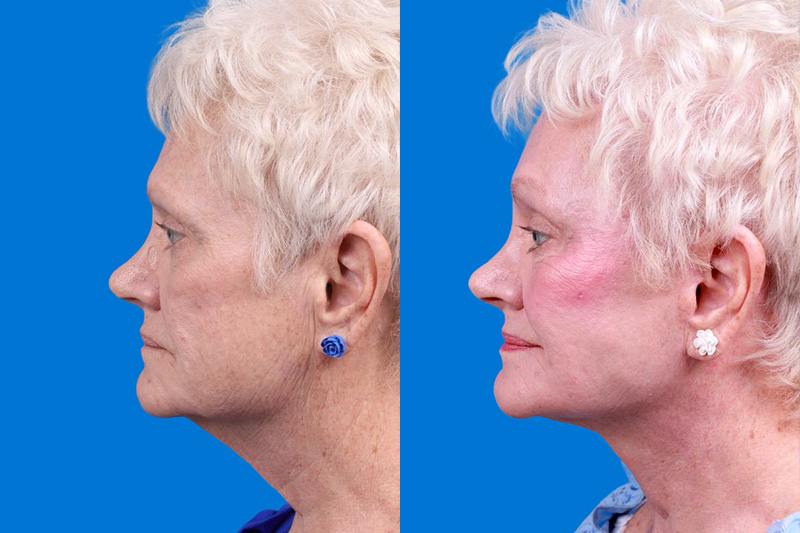 Facelift Before & After Gallery - Patient 246738 - Image 5