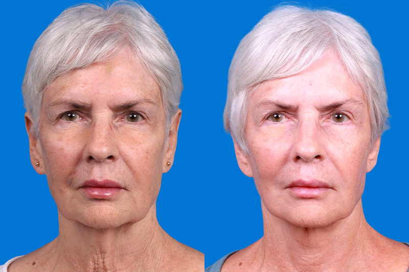 Facelift Before & After Gallery - Patient 118424 - Image 1