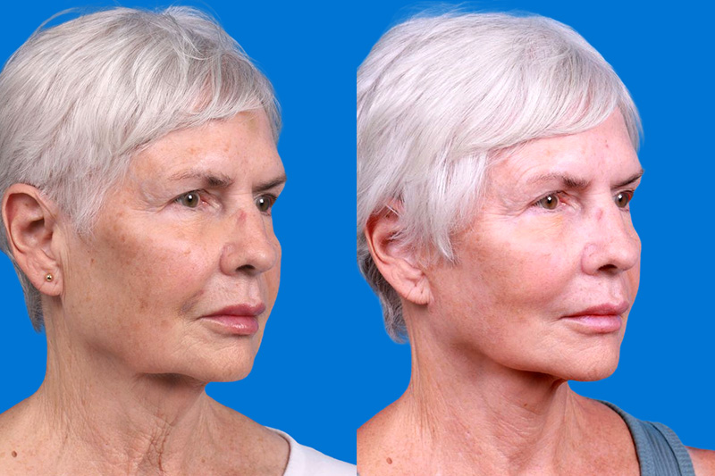 Facelift Before & After Gallery - Patient 118424 - Image 2