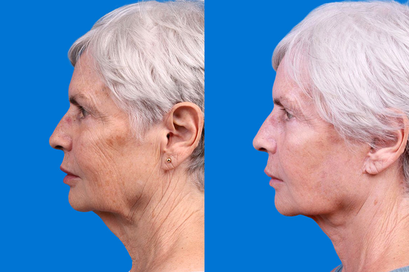 Facelift Before & After Gallery - Patient 118424 - Image 5