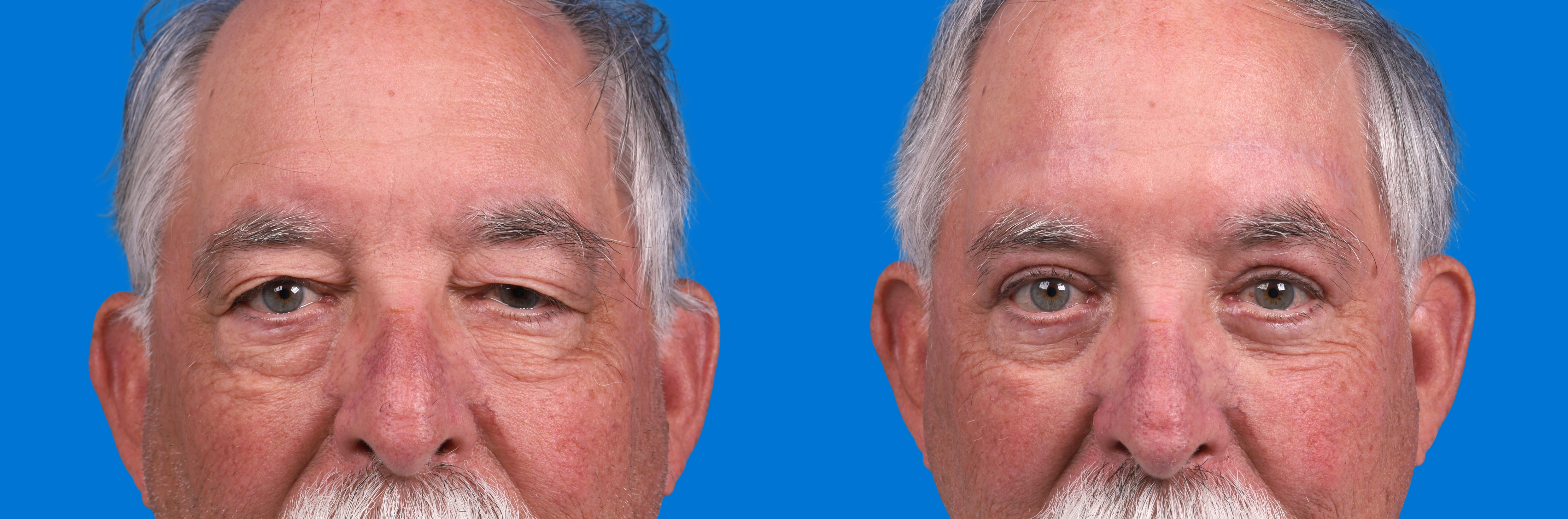 Eyelid Surgery Before & After Gallery - Patient 841229 - Image 1