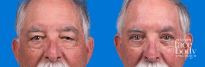 Eyelid Surgery Before & After Gallery - Patient 841229 - Image 1