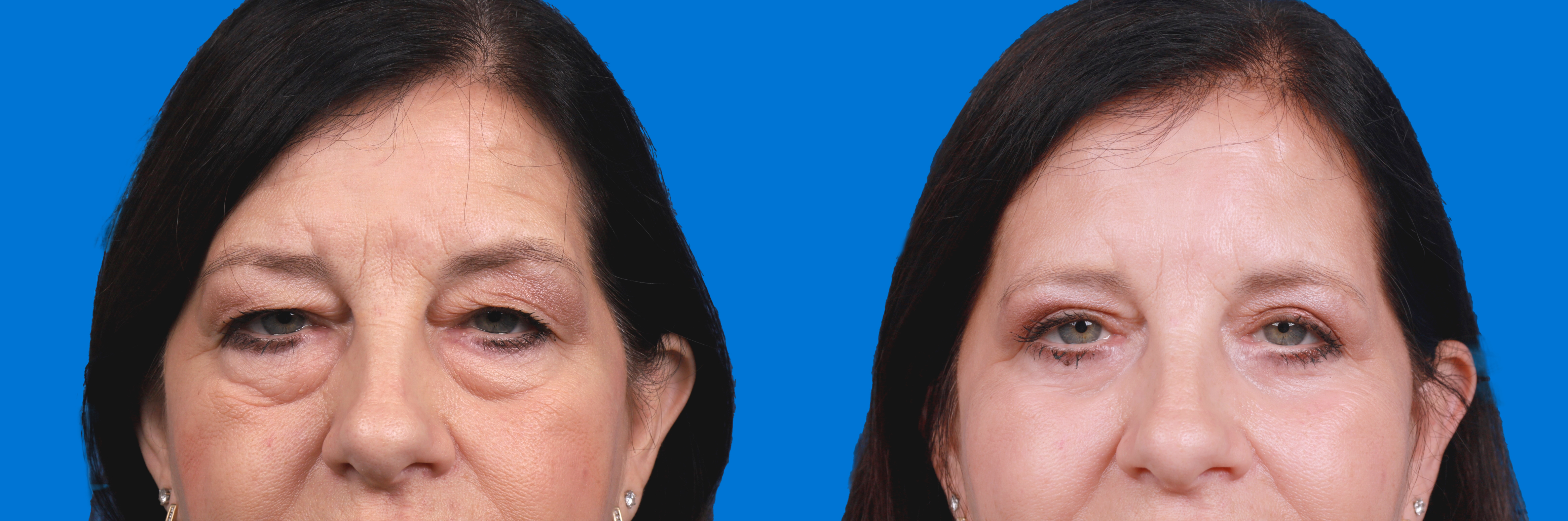 Eyelid Surgery Before & After Gallery - Patient 324900 - Image 1