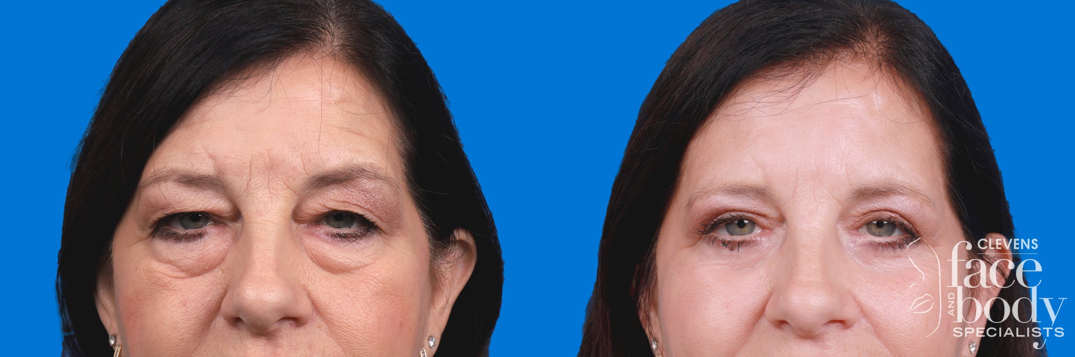 Eyelid Surgery Before & After Gallery - Patient 324900 - Image 1