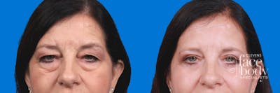 Eyelid Surgery Before & After Gallery - Patient 324900 - Image 1