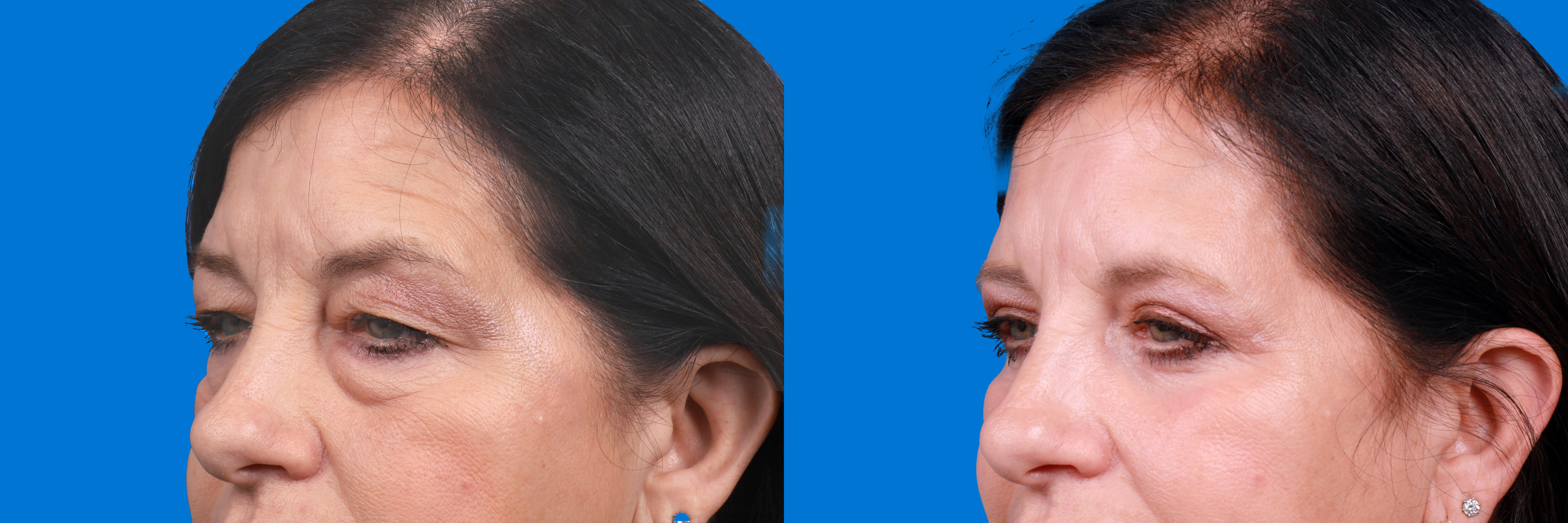 Eyelid Surgery Before & After Gallery - Patient 324900 - Image 3