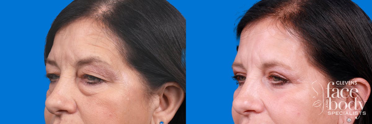Eyelid Surgery Before & After Gallery - Patient 324900 - Image 3
