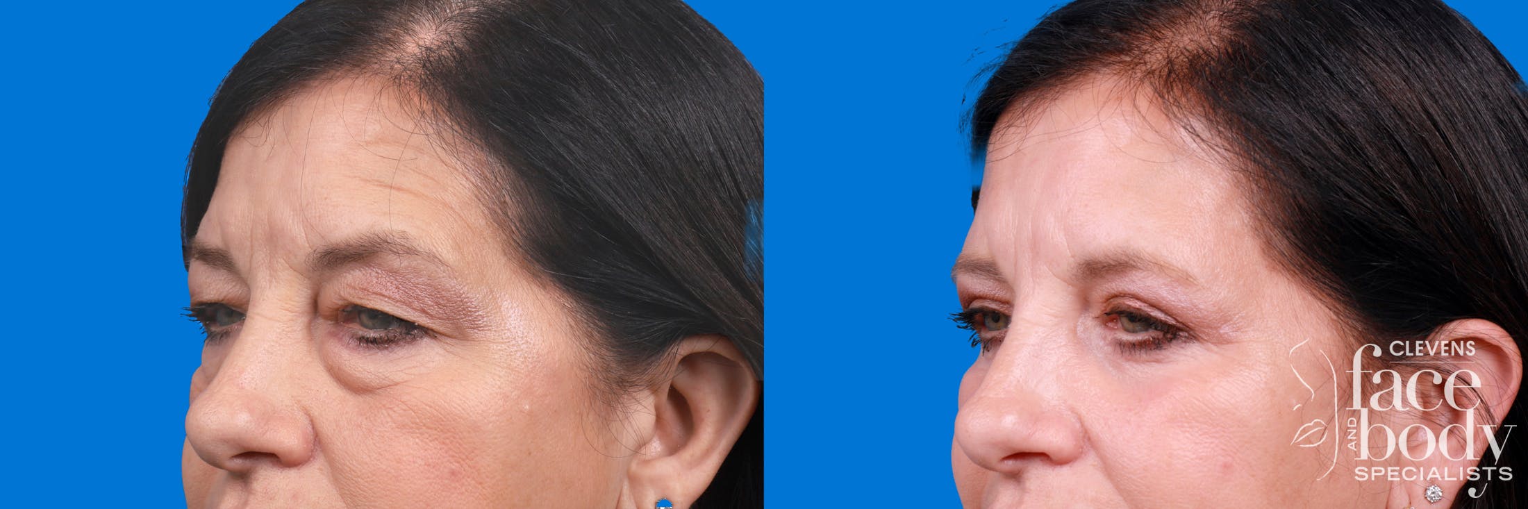 Eyelid Surgery Before & After Gallery - Patient 324900 - Image 3
