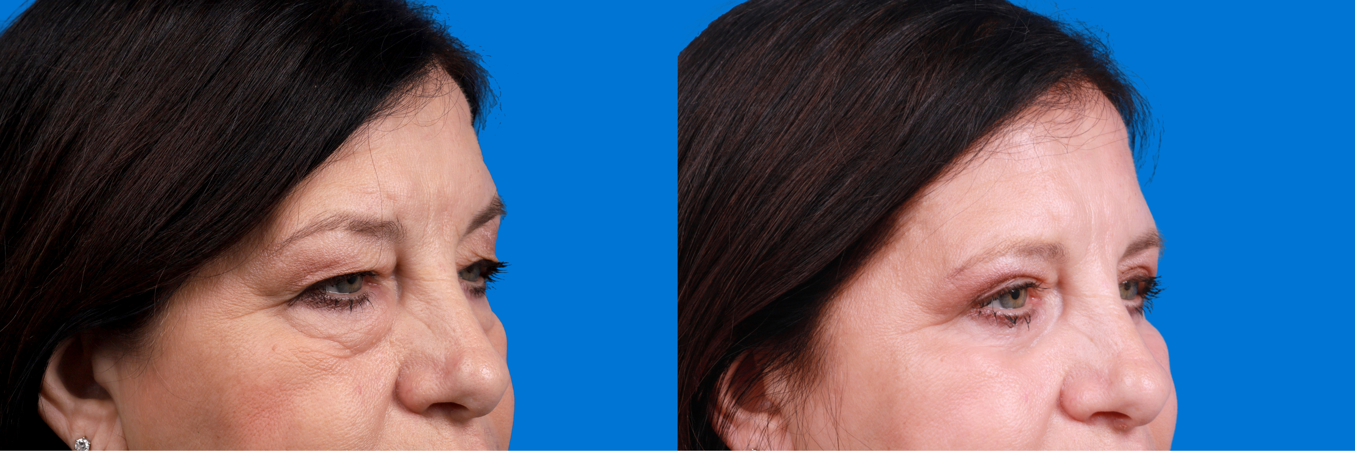 Eyelid Surgery Before & After Gallery - Patient 324900 - Image 2