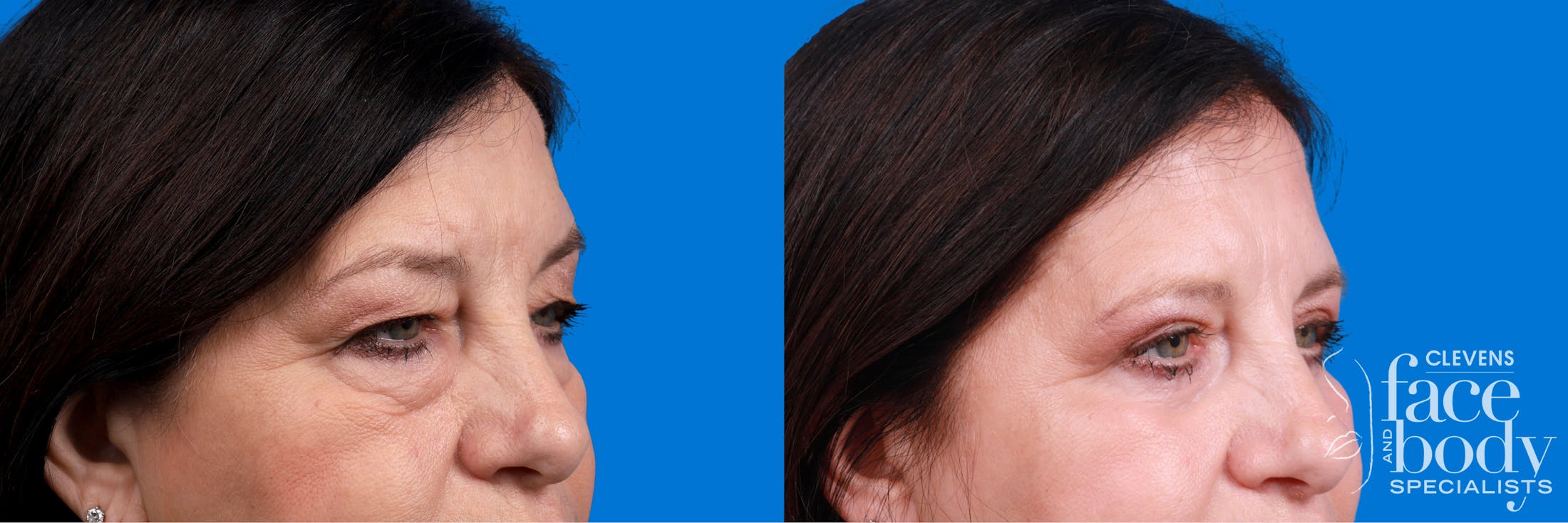 Eyelid Surgery Before & After Gallery - Patient 324900 - Image 2