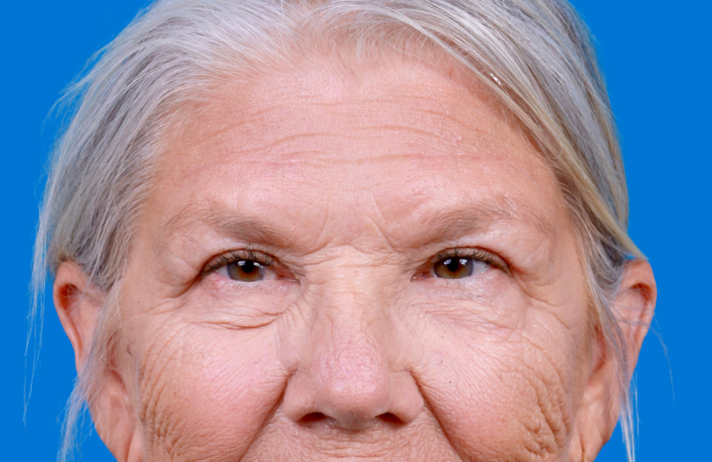 Eyelid Surgery Before & After Gallery - Patient 216425 - Image 2