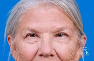 Eyelid Surgery Before & After Gallery - Patient 216425 - Image 2