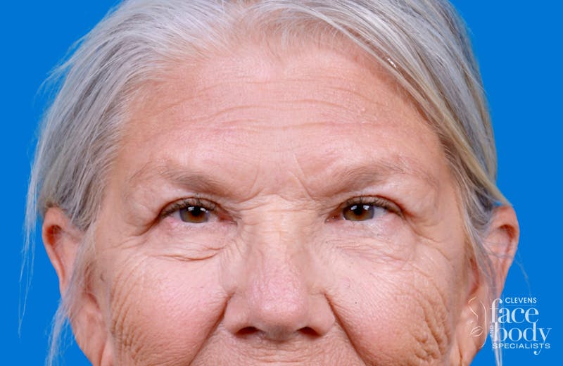 Eyelid Surgery Before & After Gallery - Patient 216425 - Image 2