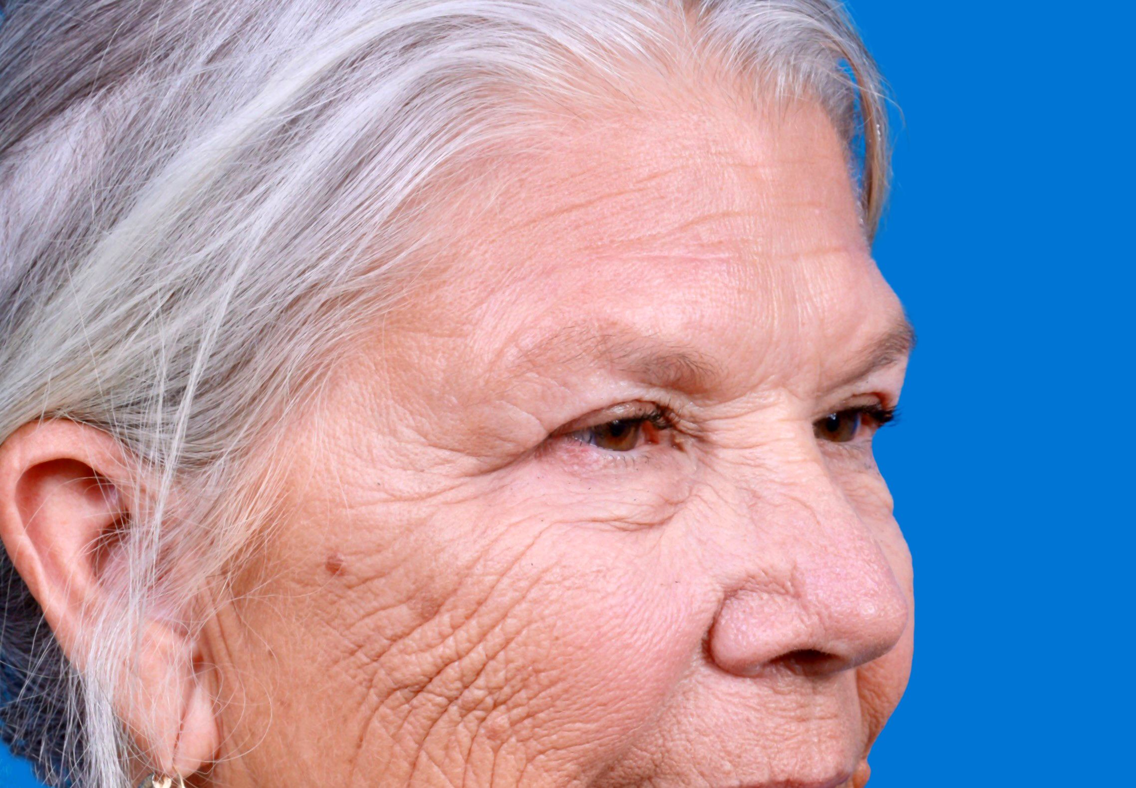 Eyelid Surgery Before & After Gallery - Patient 216425 - Image 4