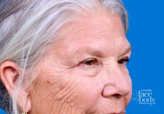 Eyelid Surgery Before & After Gallery - Patient 216425 - Image 4