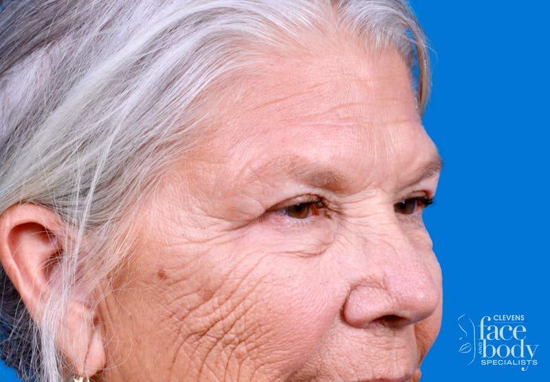 Eyelid Surgery Before & After Gallery - Patient 216425 - Image 4