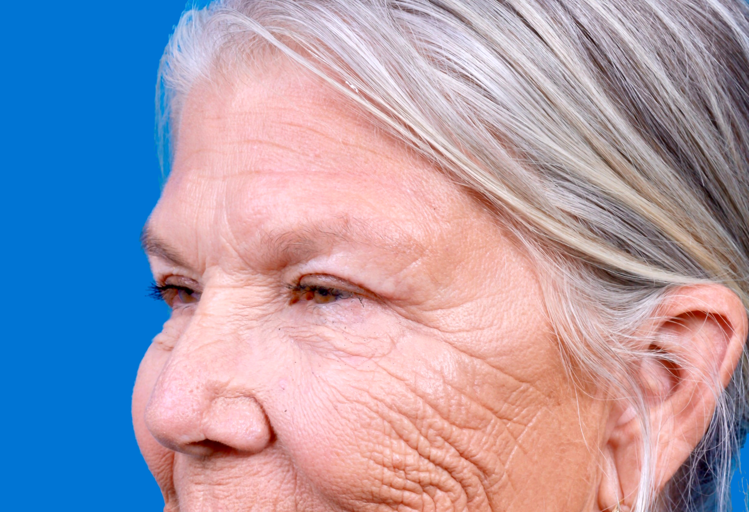 Eyelid Surgery Before & After Gallery - Patient 216425 - Image 6