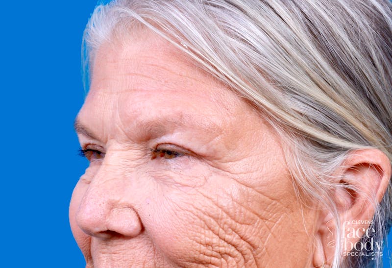 Eyelid Surgery Before & After Gallery - Patient 216425 - Image 6